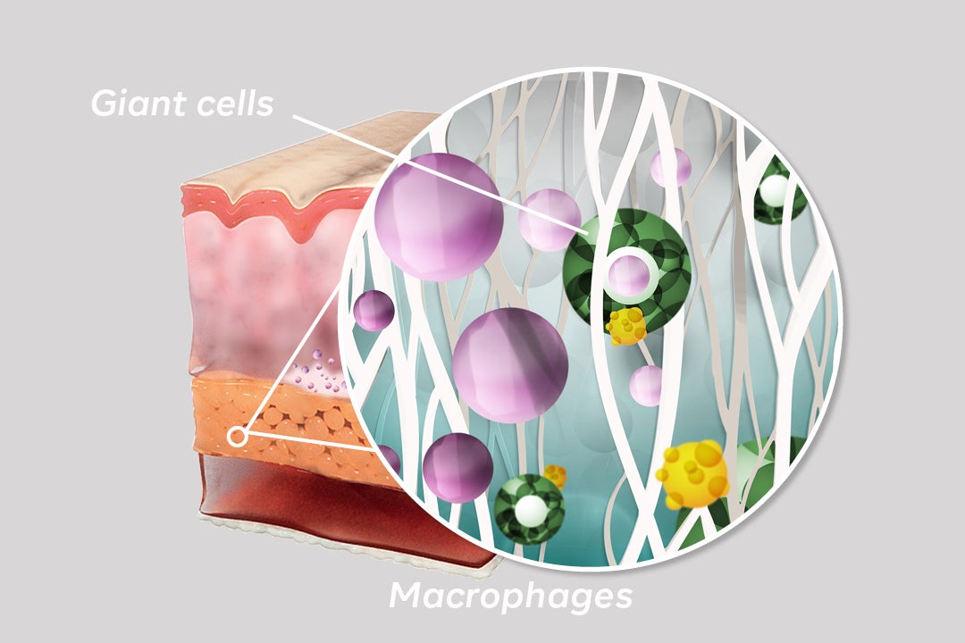  What is Sculptra - Image 4