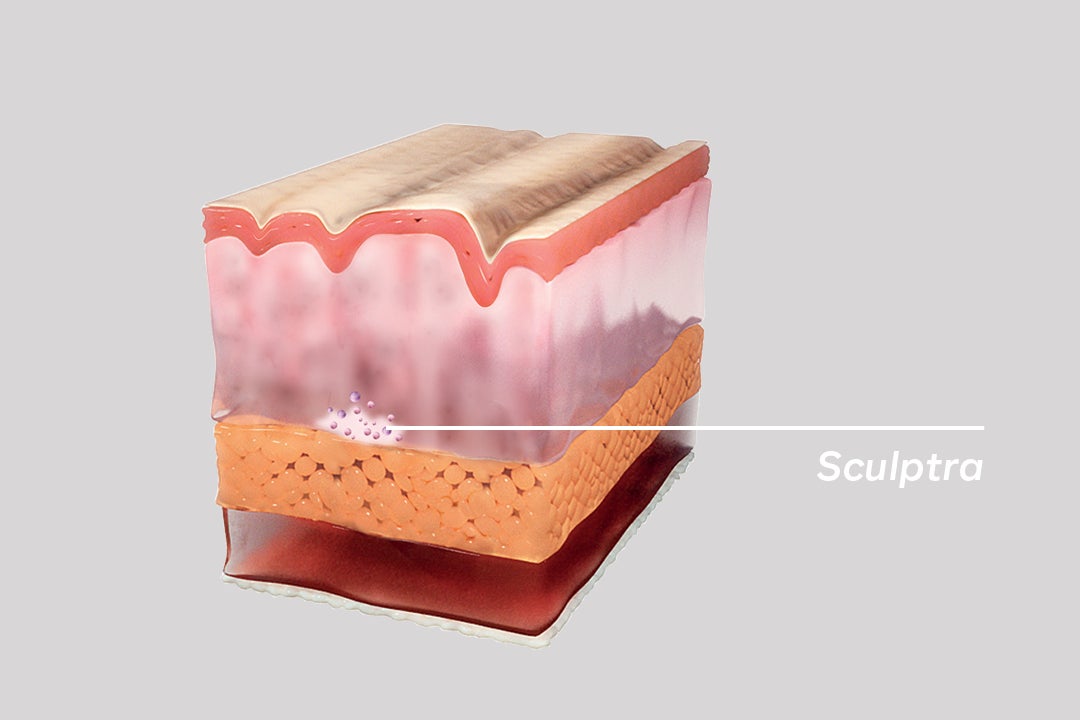 What is Sculptra Image One 